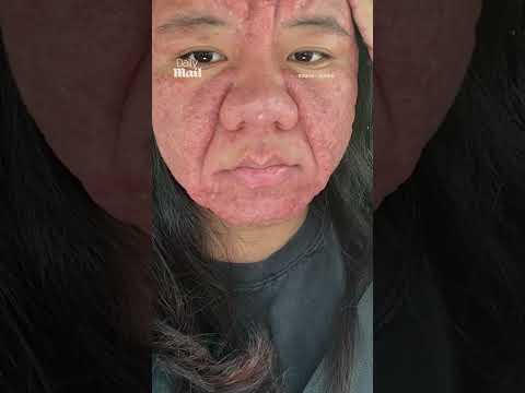 Woman's face completely changes during pregnancy